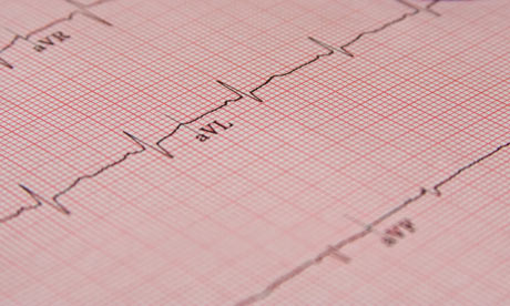 ECG traces